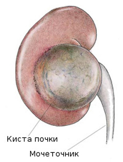 The cyst